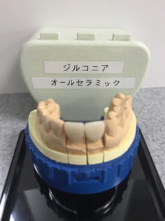 ジルコニアオールセラミック